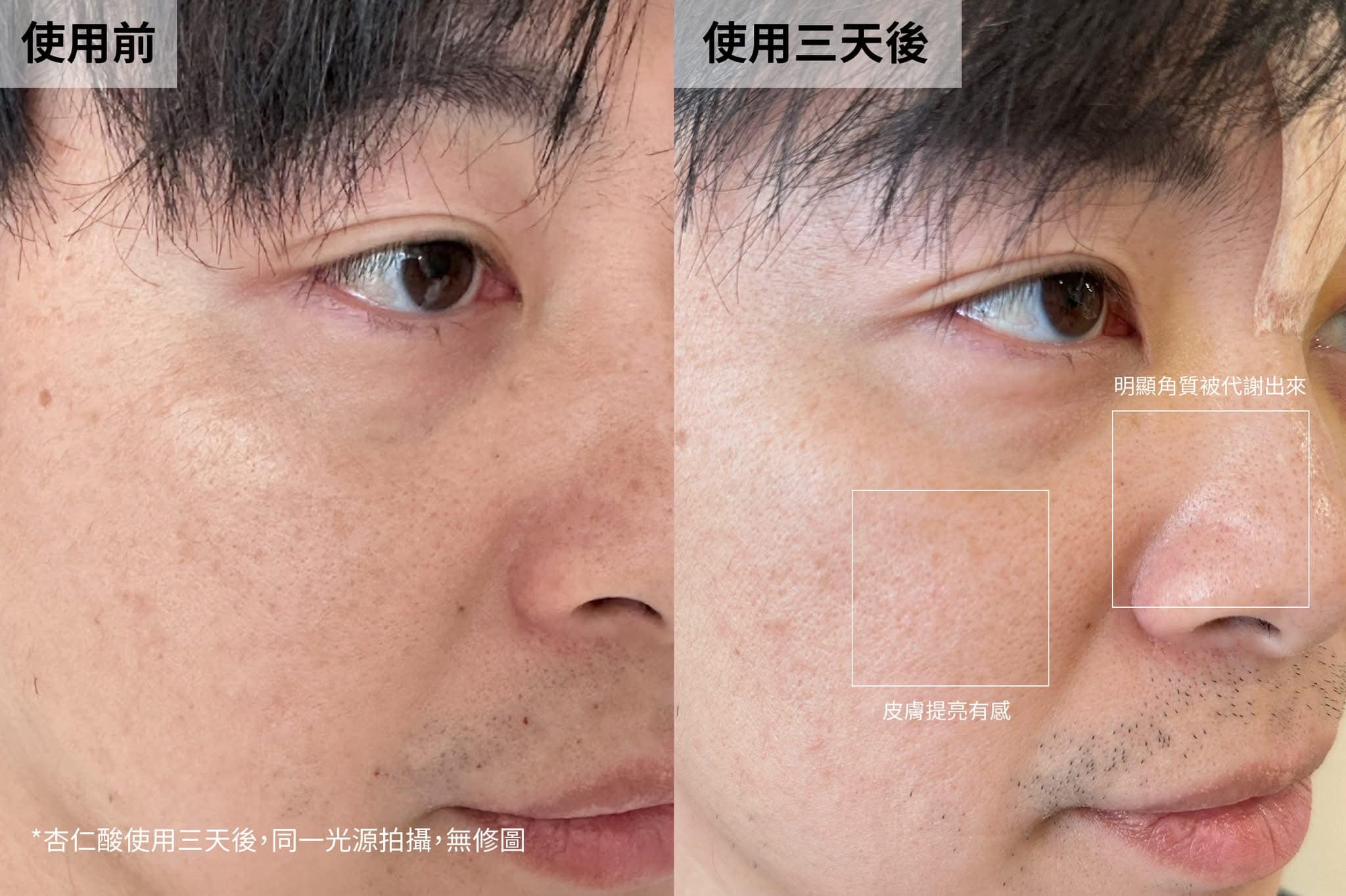 5%杏仁酸煥膚精華-三瓶